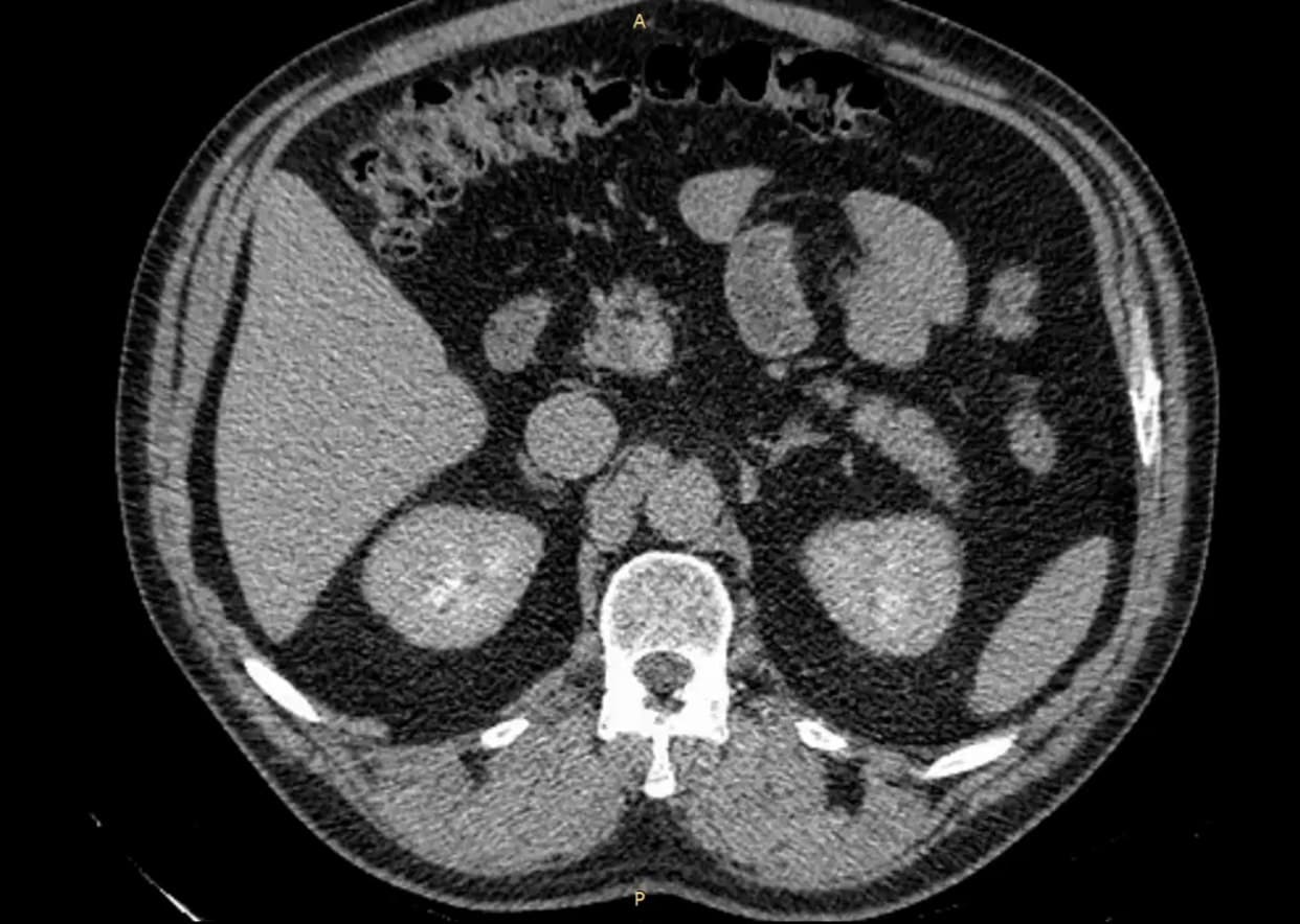 Уникальная эндоскопическая интраренальная марсупиализация