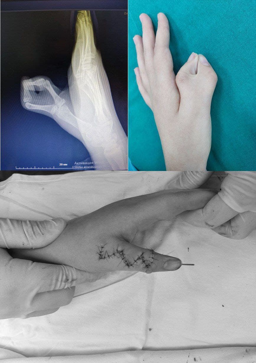 Кистевой хирург ОКБ №2 помог ребенку с врожденной патологией